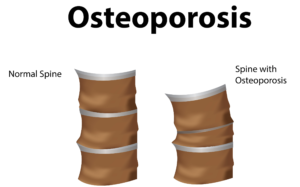 osteoprosis, stem cells, MSCs