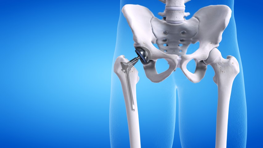 Can Hip Replacements Be Obsolete Through The Use Of Stem Cell Therapy?