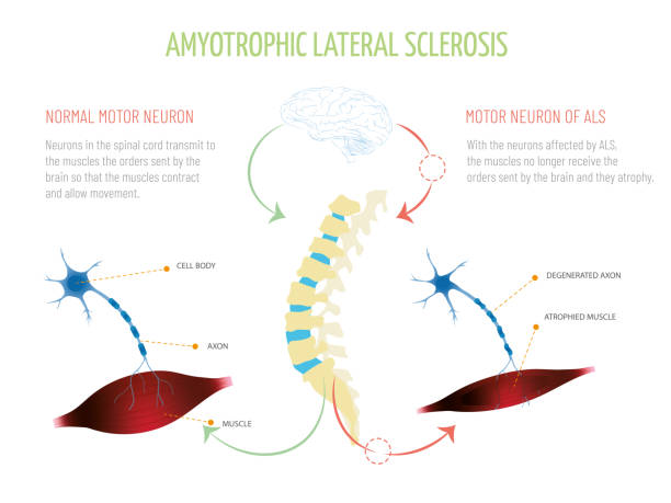 How To Effectively Treat Amyotrophic Lateral Sclerosis (ALS)